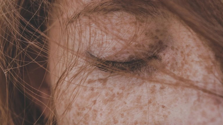 ¿Qué son las pecas y cómo evitar que aparezcan?