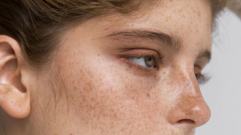 ¿Qué es el melasma y cómo tratarlo según una dermatóloga