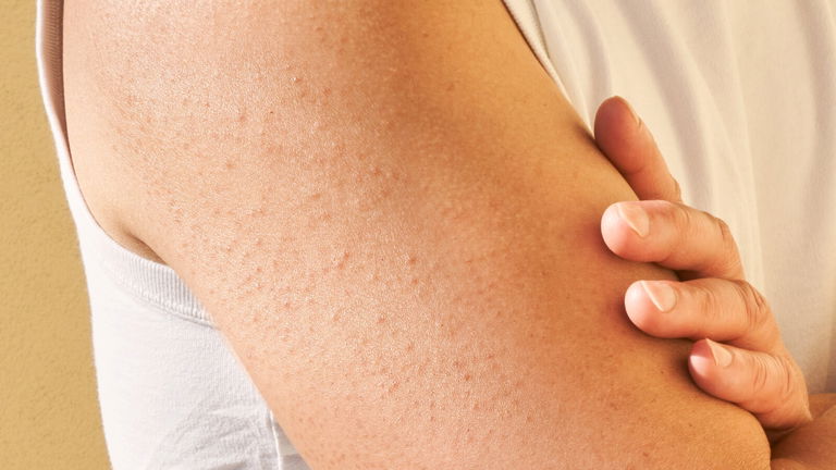 Queratosis pilar: lo que nadie te cuenta (y cómo puedes mejorarla desde hoy)