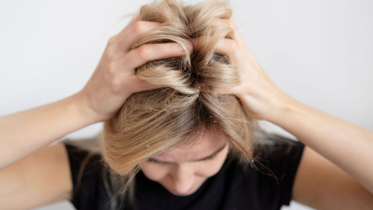 La revolución anticaspa de Klorane: el poder de la Galanga medicinal llega para cambiarlo todo